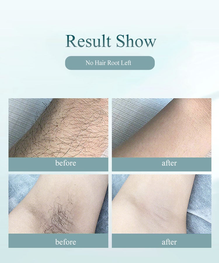 at home laser hair removal before and after
